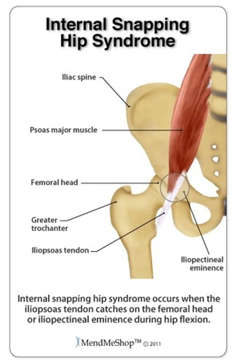 <p>- inflammation of the iliopsoas tendon, often due to overuse, especially hip flexion activities (ex. running)</p><p>- hip flexion is primarily affected</p><p>- pain can be reproduce when using the resisted straight leg raise or the Thomas test</p>