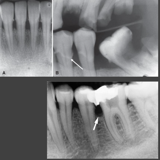 <ul><li><p>Create environment where disease may develop</p></li><li><p>Aggravate existing disease</p></li><li><p>Calculus deposits</p><ul><li><p>Prevent effective cleansing</p></li><li><p>Most commonly at mandibular incisors</p></li></ul></li><li><p>Defective restorations</p><ul><li><p>Poor contours and overhanging margins can accumulate plaque</p></li></ul></li><li><p>Enamel pearls and cervical enamel projections</p><ul><li><p>Aberrant enamel formations</p></li><li><p>Commonly in furcation regions of multirooted teeth</p></li><li><p>Alter periodontal attachment</p></li><li><p>Create sites prone to biofilm accumulation</p></li></ul></li></ul><p></p>