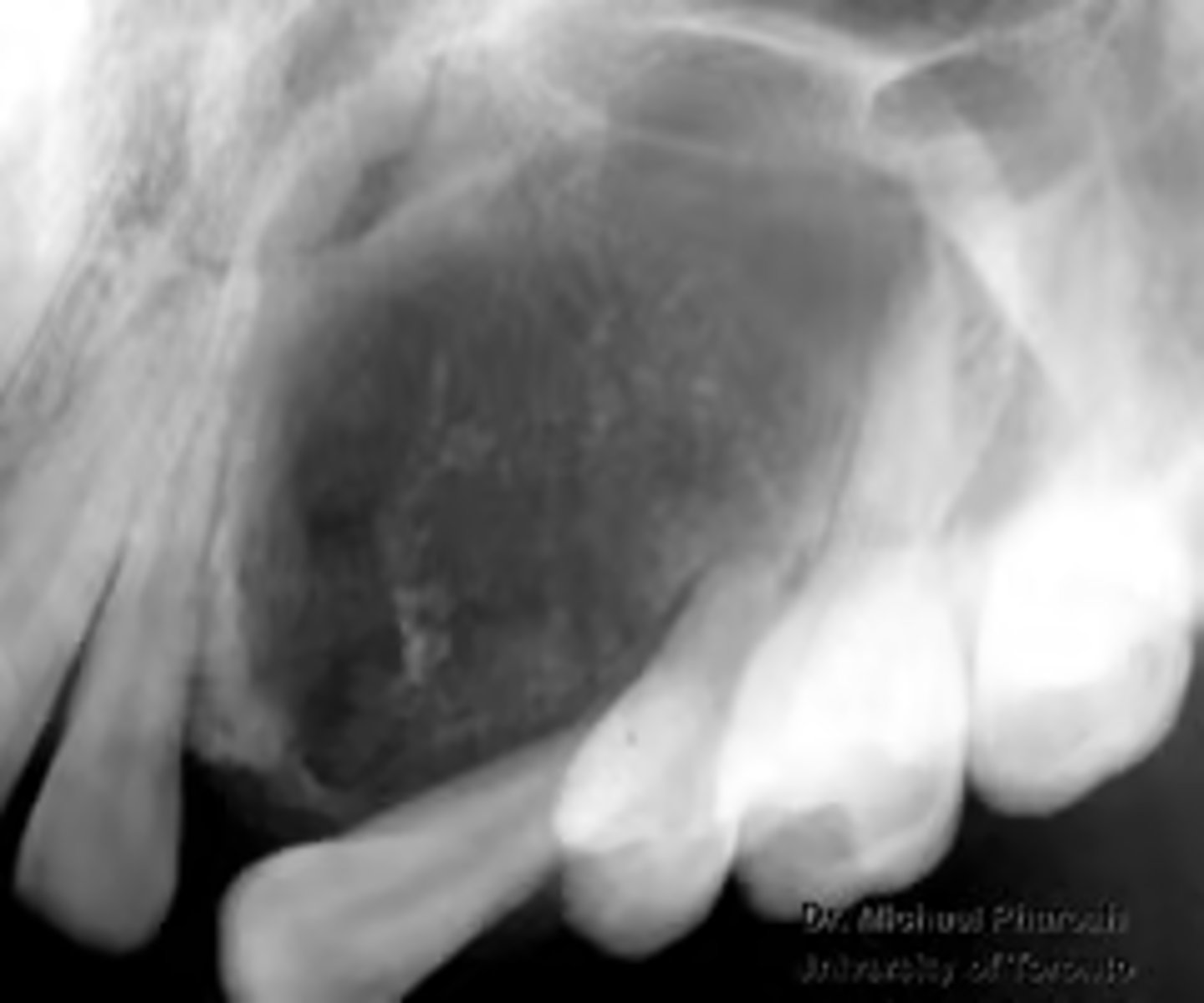 <p>What is the diagnosis?</p><p>19 y/o female patient presents with a large mass growing on the anterior maxilla. Patient is asymptomatic. Radiograph shows well-circumscribed unilocular radiolucency with fine "snowflake" calcifications surrounding impacted incisor. Radiograph shows tubular/ duct-like structures and scattered calcifications.</p>