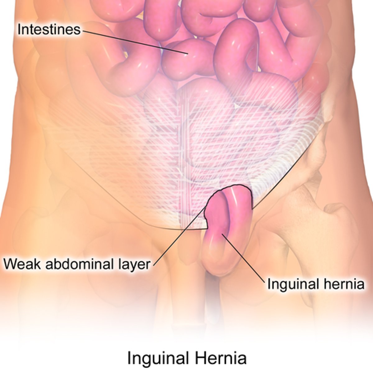 <p>Hernia, protrusion</p>