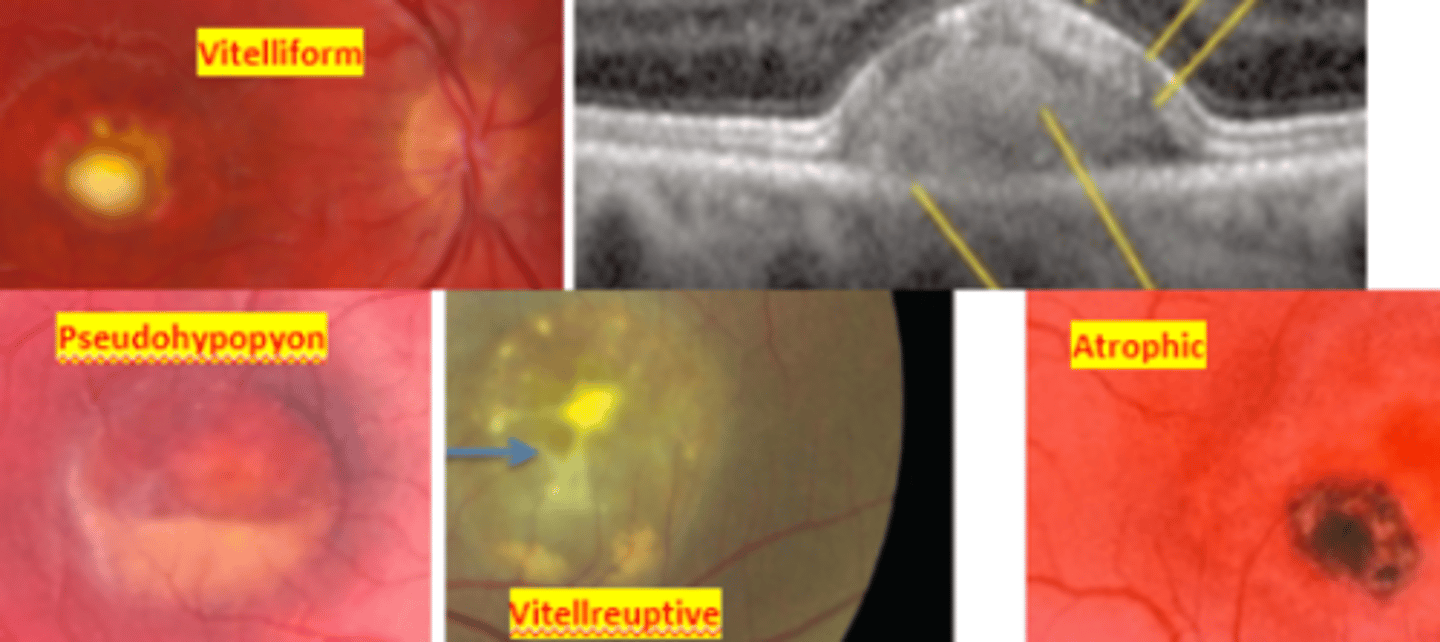 <p>an autosomal dominant disease resulting in mutation of the bestrophin gene. This results in bilateral subretinal ("egg yolk") deposits due to excessive lipofuscin accumulation in the RPE. Has a juvenile onset (3-15 yo). Patient will have abnormal EOG even when the fundus appears normal. ERG results will be normal. There is no treatment, however prognosis is good up until the 5th decade. Refer to low vision and for genetic testing.</p>
