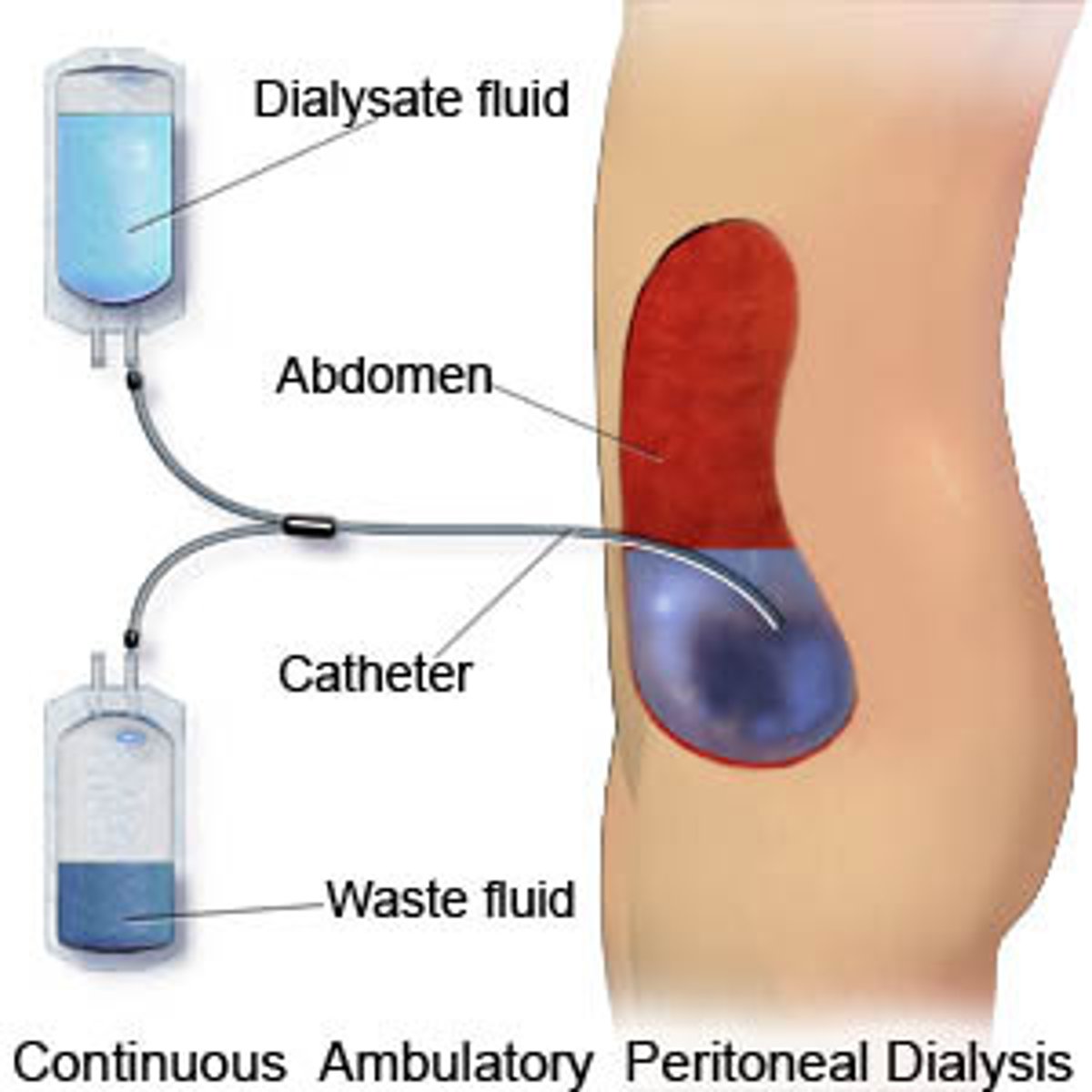 <p>This type of dialysis uses the peritoneum, a lining in your abdomen, as a filter. A solution called dialysate is put into your abdomen through a catheter.</p>