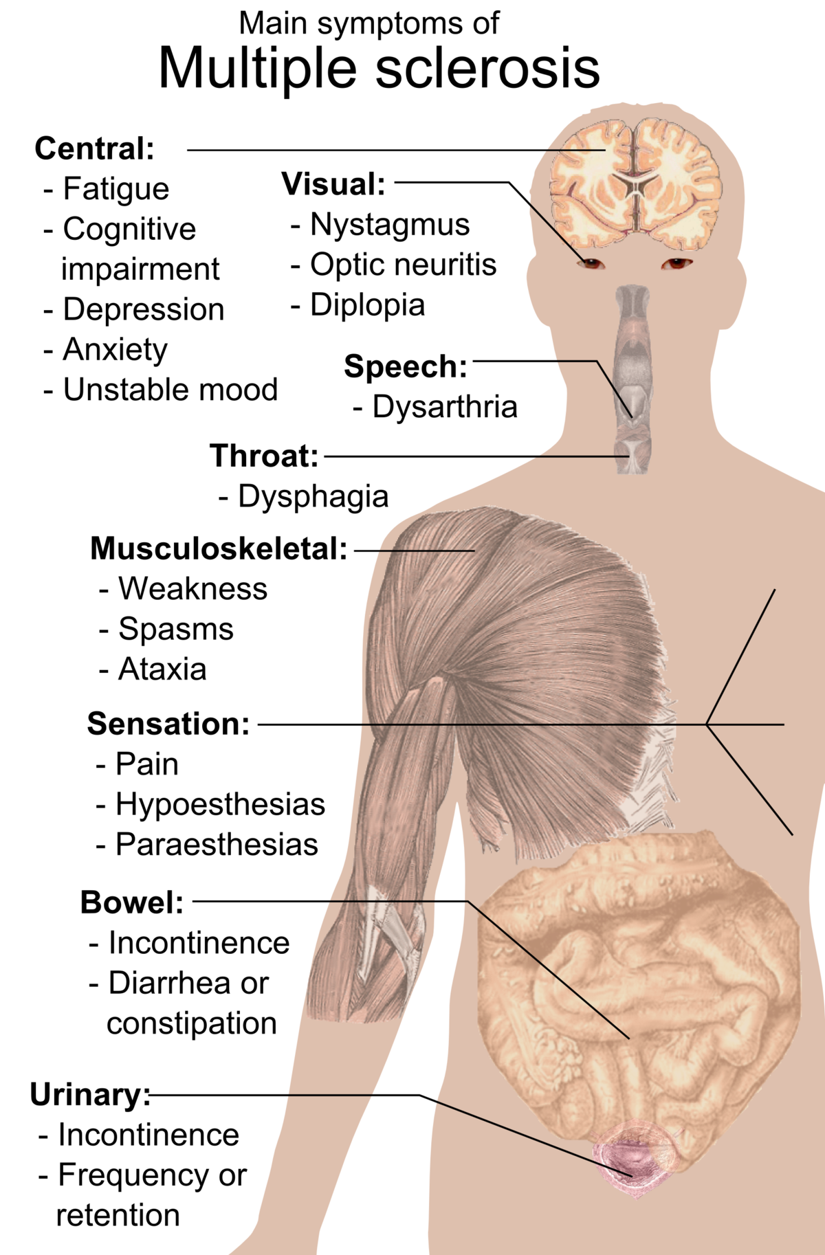 <p></p><p>Chronic autoimmune disease affecting the central nervous system. The nervous system eats away at itself, causing nerve damage. Symptoms include fatigue, vision problems, numbness, tingling, muscle spasms, weakness, stiffness, pain (in back or eyes with head or eye movement), mobility issues, impaired coordination</p>