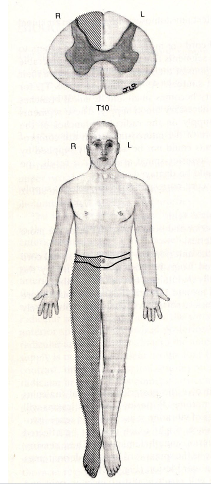 <p>which sensory (ascending) pathway is lesioned here? which motor (descending) pathway is lesioned?</p>