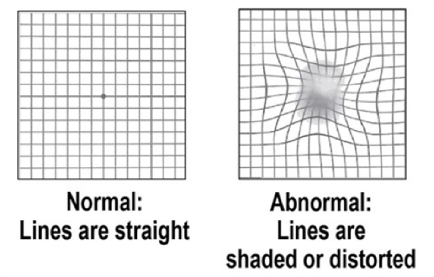 <p>Patients experience metamorphopsia (visual distortion), scotomas (blind spots), and loss of central vision.</p>