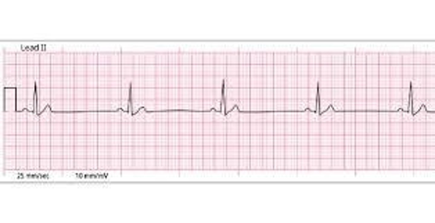 <p>1. Regular Rhythm 2. Rate: 60-100 bpm 3. P wave (sinus) 4. PR-Interval (sinus) 5. QRS (WNL)</p>