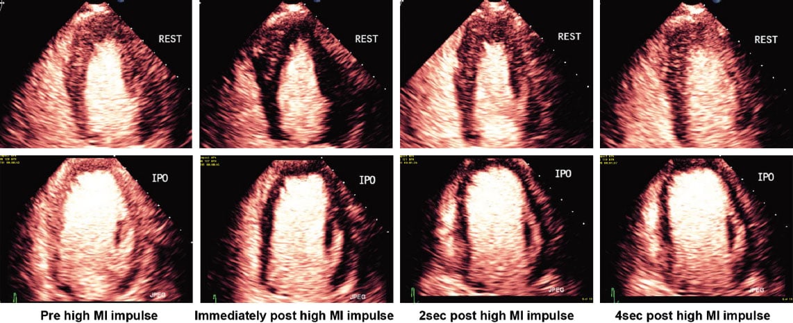 <p>high MI impulse images with contrast — what coronary artery explains the perfusion defect?</p>