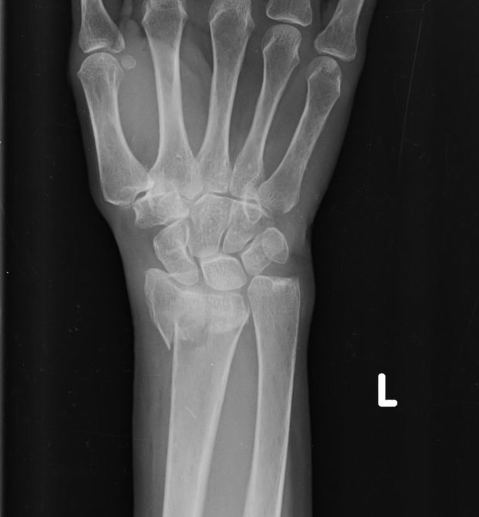 <ul><li><p><span>bone breaks due to a twisting or rotational force</span></p></li><li><p><span>evident by superimposition (overlap) of structures</span></p></li></ul><p></p>