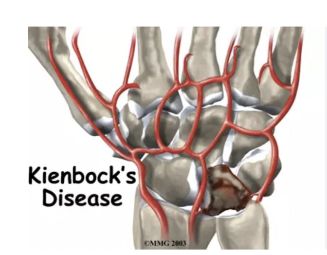 <p>-persistent injury</p><p>• Avascular necrosis of the lunate</p><p>• Repetitive microtrauma (maybe gymnasts, jackhammer)</p><p>*tissue dying because not getting enough blood (also worry about this for scaphoid injuries)</p><p>*bone starts to die because not getting the nutrients it needs to survive</p>