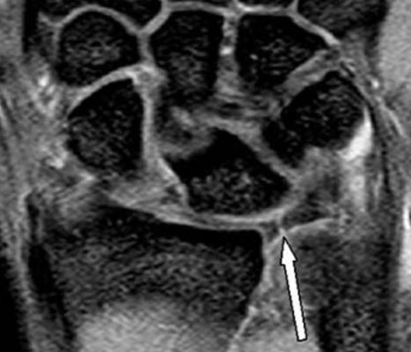 <p>Due to the complexity of the TFCC and nearby ulnar wrist structures, the ulnar wrist is commonly referred to as the "black box of the wrist".</p><p>Mechanism of injury:</p><p>Trauma on the ulnar side of the wrist through fall or</p><p>weightbearing</p><p>Presentation and management:</p><p>- Ulnar-sided wrist pain exacerbated by weightbearing on</p><p>extended wrist or forearm rotation</p><p>- Diagnosis is made through a combination of clinical exams</p><p>and imaging</p><p>- Surgery is recommended for unstable traumatic tears</p><p>- Splinting and therapy is recommended for painful but stable</p><p>tears</p>
