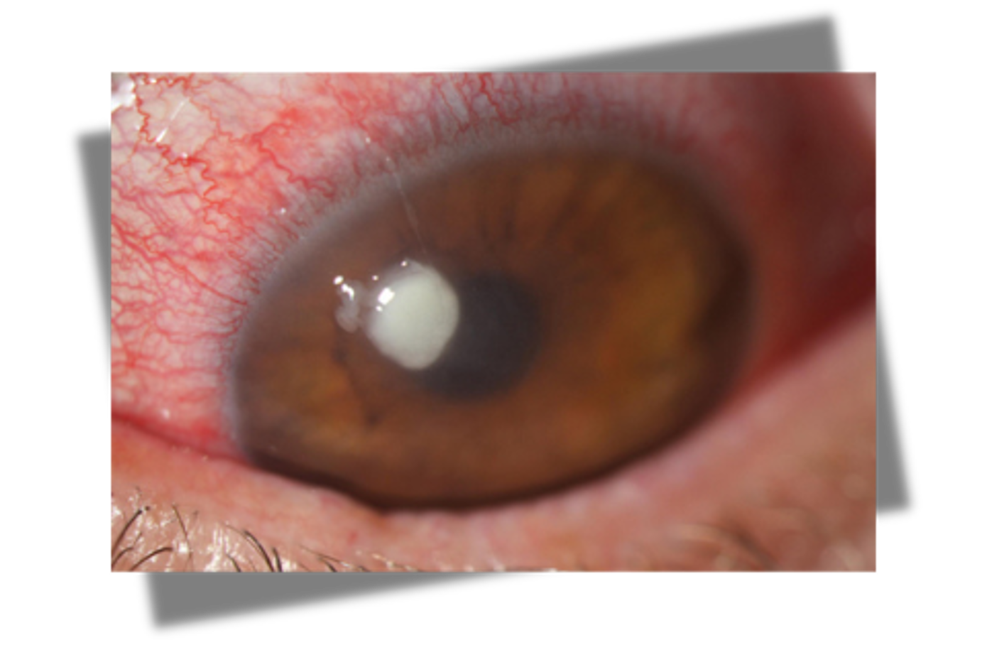 <p>red, painful eye, corneal opacity</p>