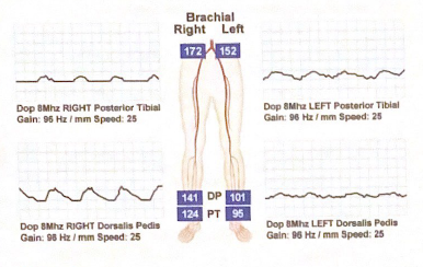 <p>Calculate the ABI for each pedal artery bilaterally</p>
