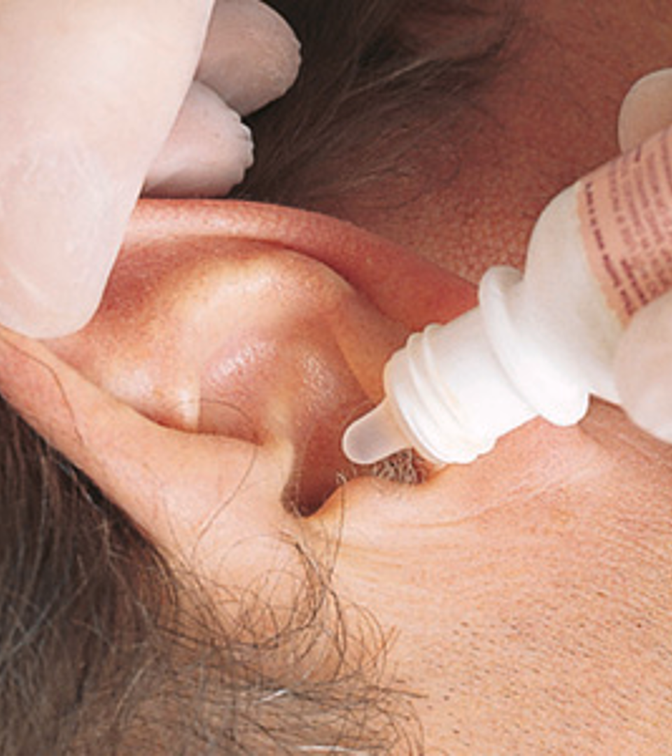 <p>Drops or irrigations.</p><p>Sensitive to temperature changes.</p><p>Straighten ear canal prior to installation.</p>