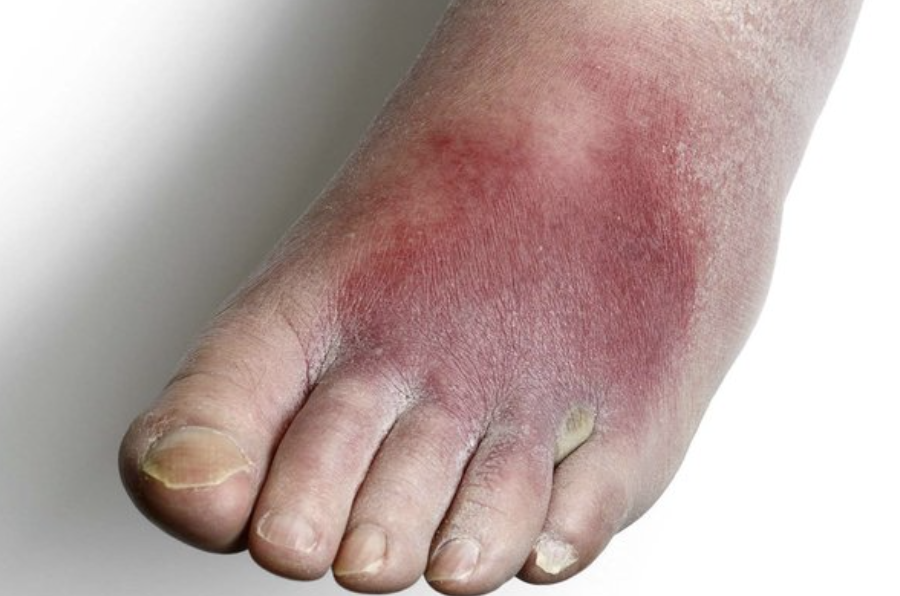 <p>Inflammation of cellular or connective tissue</p>