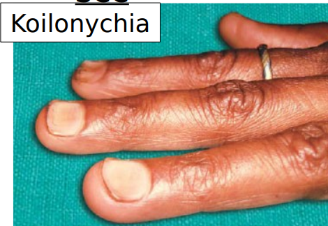 <ul><li><p>iron deficiency anemia </p></li><li><p>dysphagia </p></li><li><p>koilonychia </p></li></ul><p></p>