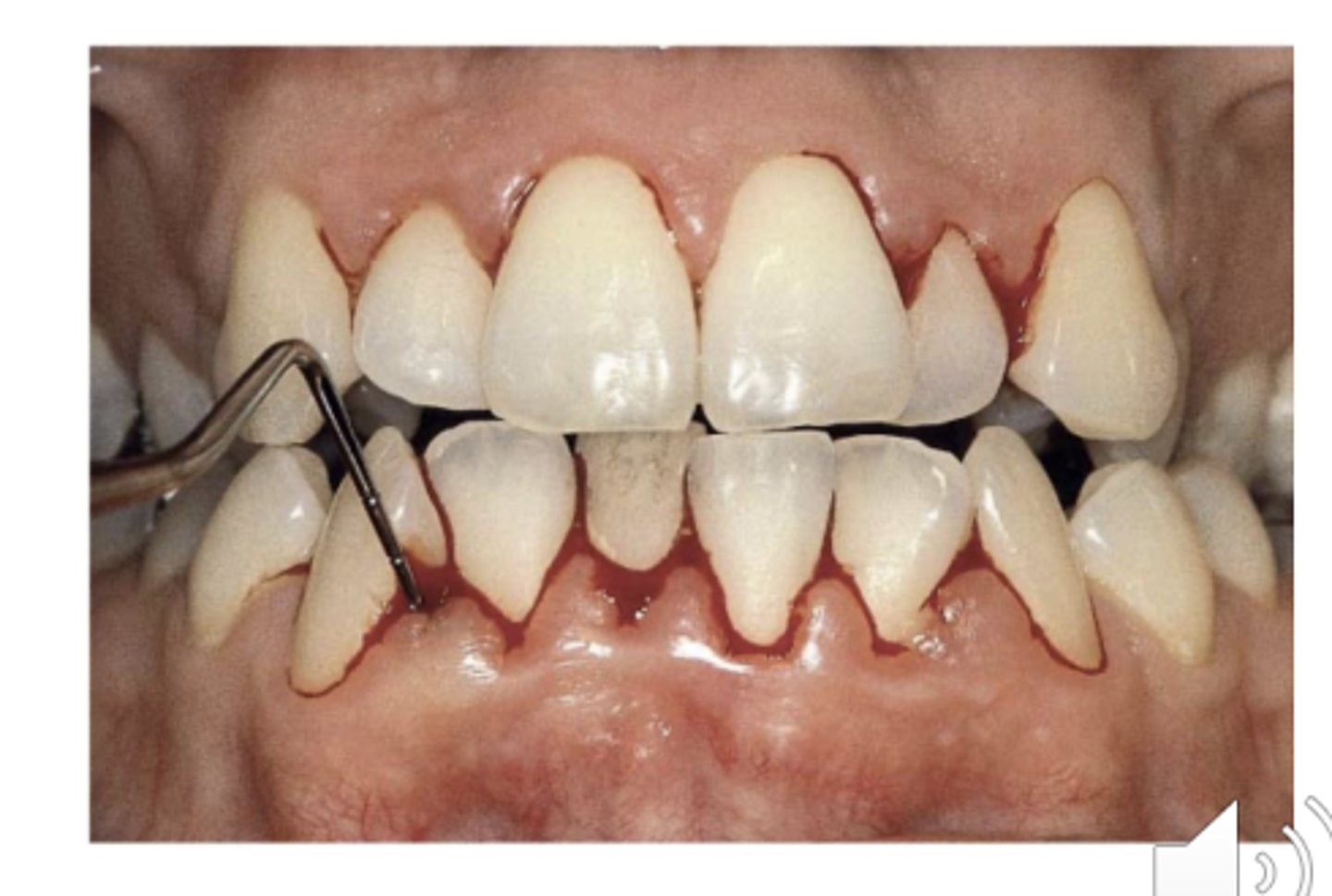 <p>inflammatory changes in the marginal gingiva</p>