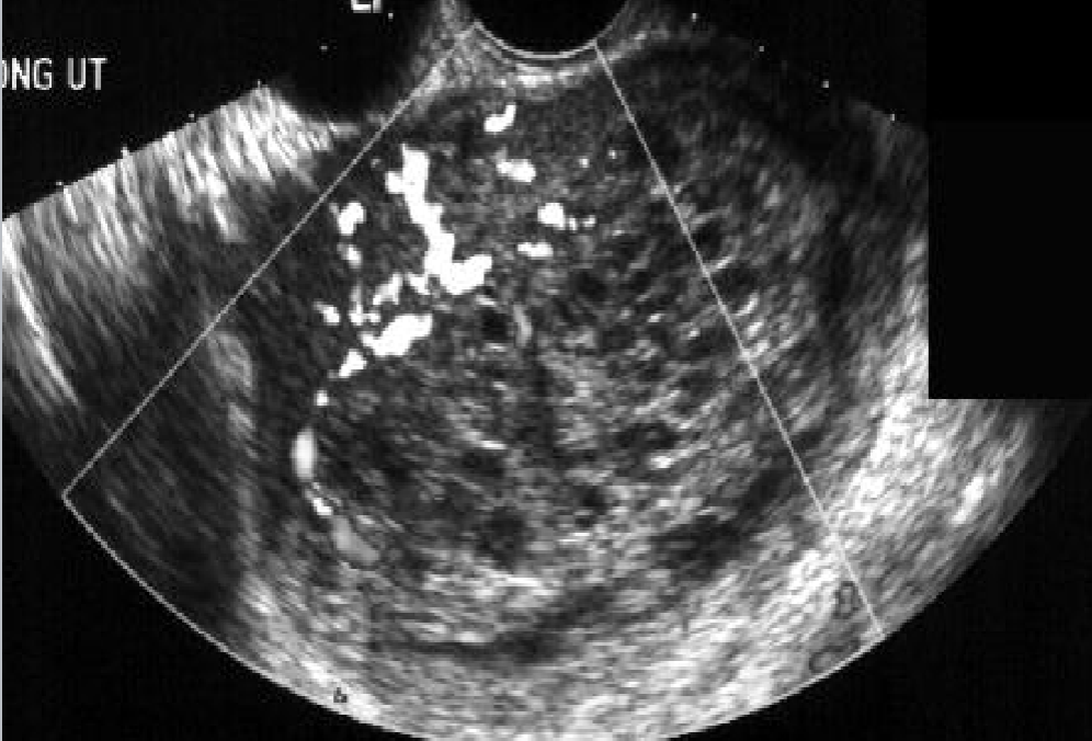 <ul><li><p><span style="color: rgb(255, 0, 0);">Most common neopasm that arises from the trophoblast</span></p></li><li><p>May develop into <u>choriocarcinoma</u></p></li><li><p>Complete hydatidiform moles are masses that <strong>arise from either:</strong></p><ul><li><p>fertilization of a defective ovum by a single sperm</p></li><li><p>OR fertilization of one ovum by two sperm</p></li></ul></li></ul><p></p>