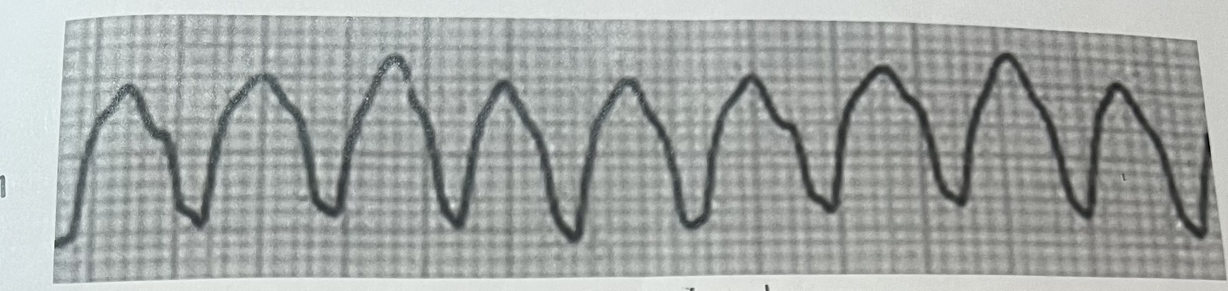 <p>Ventricular Tachycardia (V-tachycardia) aka monomorphic tachycardia</p>