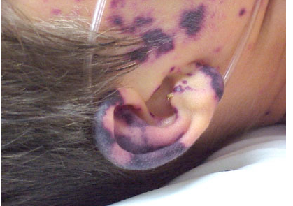 <p>20yo man w/ 12 hrs increasing fever &amp; confusion. never seen dr. no meds, 104F, delirious, diffuse rash over body</p>