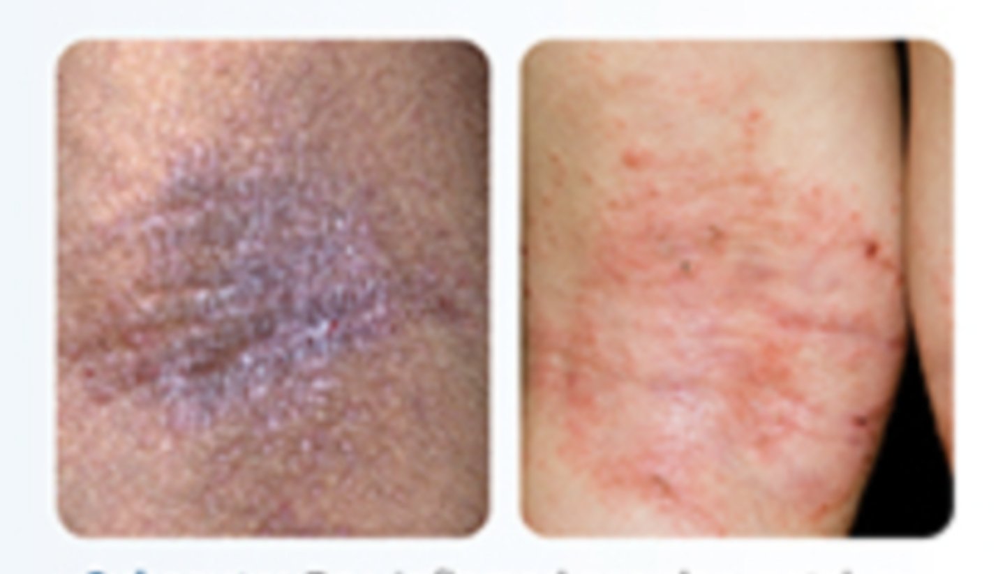 <p>dry and inflamed</p>