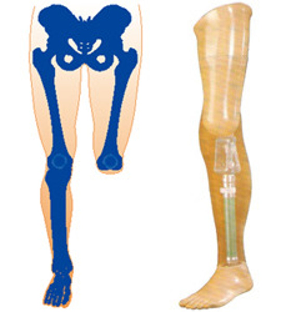 <p>Knee disarticulation</p>