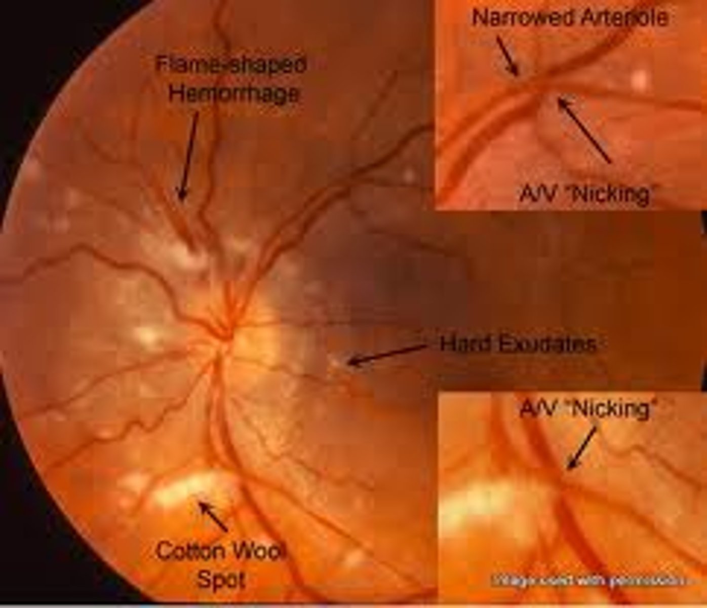 <p>1. Narrowing of vessels</p><p>2. Increased vascular tortuosity</p><p>3. Copper wiring (red-brown reflex)</p><p>4. Arteriovenous nicking</p><p>5. Retinal hemorrhages</p>