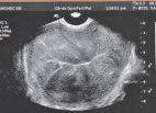 <p>the granular appearance of images that is caused by interference of echoes from the distribution of scatterers in tissue</p>