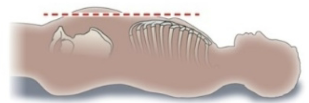 <p>Abdomen appears swollen or enlarged due to excess gas, fluid, or other substances. </p>