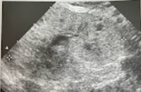 <p>A 10 year old child presented w/hx of enlarged echogenic kidneys, hepatosplenomegaly, and evidence of portal hypertension. Renal function tests reveal the child is in moderate renal failure. Discuss the clinical findings and significance of the appearance of the kidney and the associated liver abnormalities. </p>
