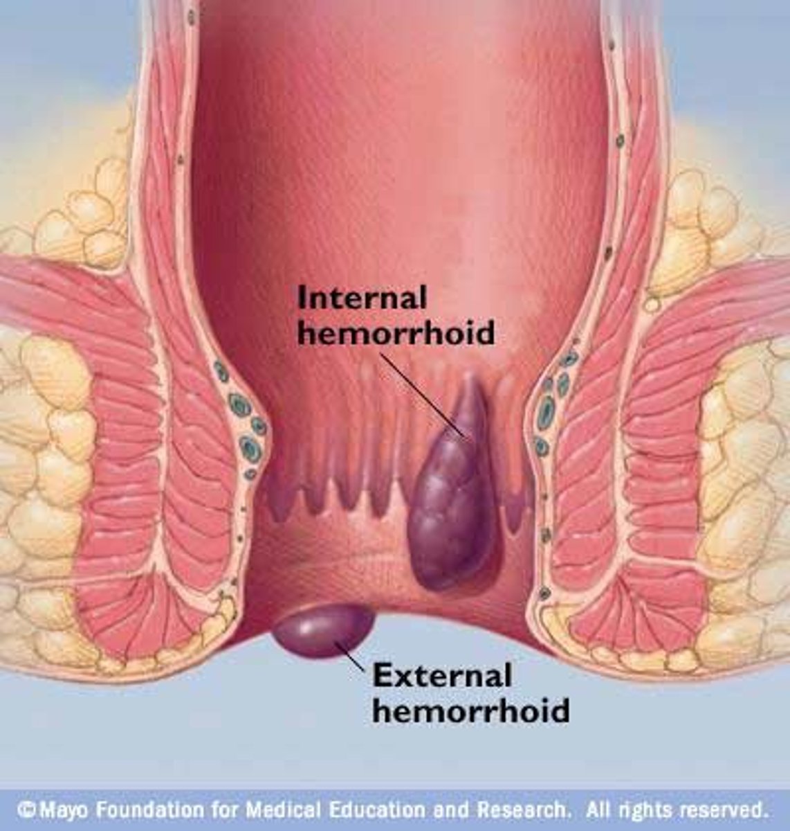 <p>[Internal] Located superior to the pectinate line -&gt; Leads to bleeding<br><br>[External] Located inferior to the pectinate line -&gt; Leads to itchiness and irritation</p>