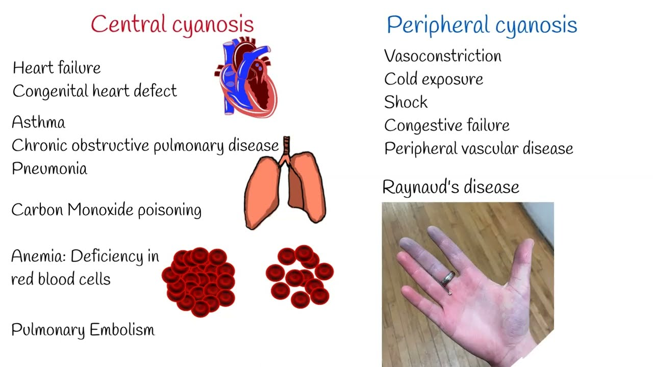 <p>either <strong>peripheral</strong> or <strong>central:</strong></p><ul><li><p>Central cyanosis:</p><ul><li><p>bluish lips, tongue (especially the underside), and oral mucous membranes (use a light)</p></li><li><p>causes:</p><ul><li><p><span>cyanotic congenital heart disease with right-to-left shunt</span></p></li><li><p><span>respiratory disease e.g. COPD and pulmonary embolism</span></p></li><li><p><span>high altitude + resultant decreased inspired oxygen concentration</span></p></li><li><p><span>polycythaemia (increased hematocrit and/or hemoglobin concentration)</span></p></li><li><p><span>haemoglobin abnormalities</span></p></li></ul></li></ul></li><li><p>Peripheral cyanosis </p><ul><li><p>bluish discoloration of the hands, nail beds and feet</p></li><li><p>causes:</p><ul><li><p>All causes of central cyanosis cause peripheral cyanosis</p></li><li><p><span>exposure to the cold</span></p></li><li><p><span>reduced cardiac output </span></p></li><li><p><span>arterial or venous obstruction</span></p></li></ul></li></ul></li></ul><p><em>can reflect poor oxygenation, reduced perfusion, or anaemia</em></p>
