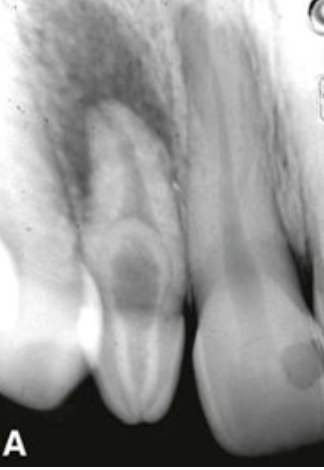 <p>Dit is een heel bijzonder fenomeen waarbij een tand in een tand zit. Dit komt het meest voor in de laterale boven incisief.&nbsp;</p>