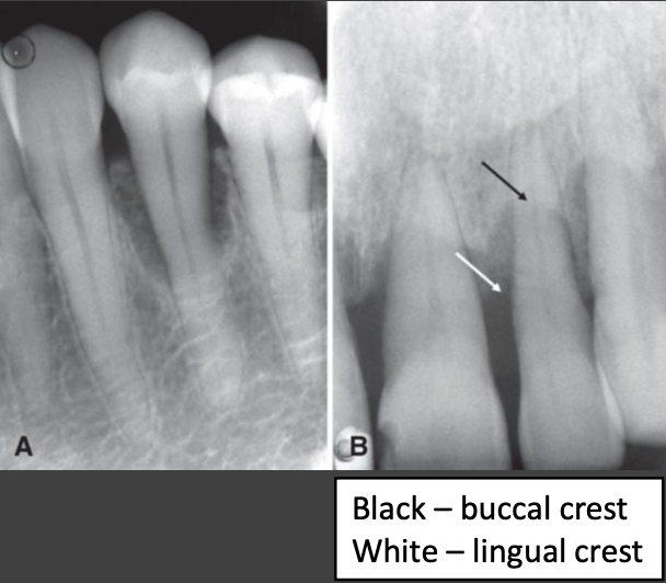 <ul><li><p>Loss of cortical plate overlying tooth root</p><ul><li><p>Difficult to detect if lack of bone loss at interproximal region</p></li></ul></li><li><p>May occur alone or with another type of bone loss</p></li><li><p>Increase in radiolucency of tooth root near alveolar crest</p><ul><li><p>Shape is usually semicircular with depth directed apically</p></li></ul></li></ul><p></p>