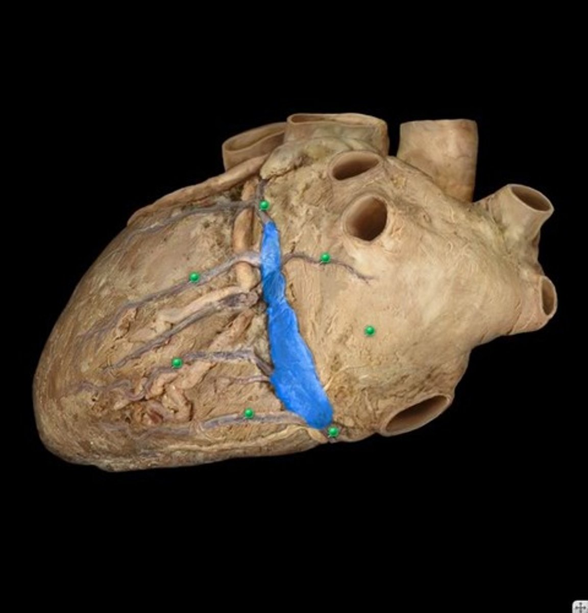 <p>enlarged vessel on the posterior aspect of the heart that empties blood into the right atrium</p>