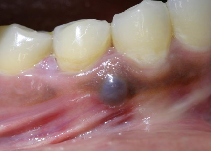 <p><strong>Adults</strong>, most common location is between mandibular canine &amp; PM, surgical excision</p>