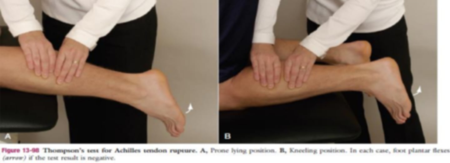 <p>- achilles tendon</p><p>(+): absence of PF when muscle is squeeze = ruptured achilles tendon (3rd degree); ThomPson test, Pump the calf to assess achilles</p>