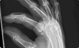 <p>Nonexistent joint seen in X ray</p>