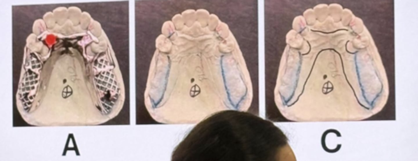 <p>-there are two separate external finish lines</p><p>-there is a true RPI system in this design</p><p>-shows the carving on the maxillary model to seal and prevent food impaction</p><p>-Picture b there is a prepped canine for indirect retention</p>