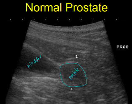 <p>Prostate gland disease on Ultrasound</p>