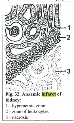 <p><strong>Infarctus renis anemicus </strong><em>(anaemic infarct of kidney)</em></p><img src="https://knowt-user-attachments.s3.amazonaws.com/f599d75e-e39d-4157-bdfe-7f614e1b3a65.png" data-width="50%" data-align="center"><p></p>