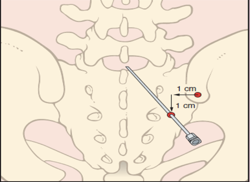 <p>usually in elderly arthritic males bc the ligaments at this level do not calcify </p>