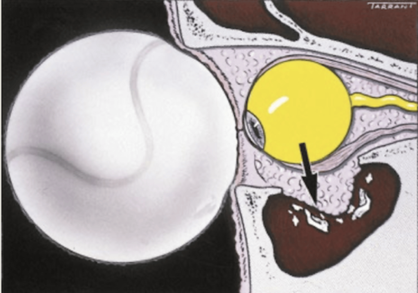 <p>1. orbital floor (48%)</p><p>2. medial wall</p><p>force is displaced inferior and transmits energy from impact</p>