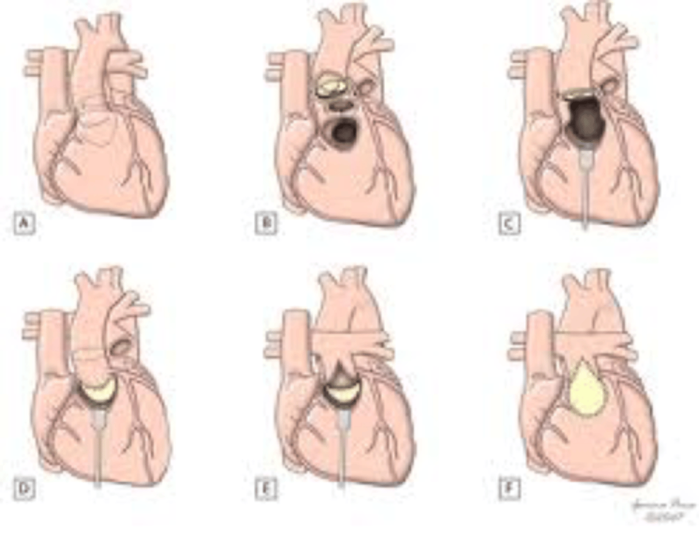 <p>when vsd is shallow and unfavorably located then removal of stenotic LVOT and translocation of the aortic root to the LVOT helps long term results.</p>