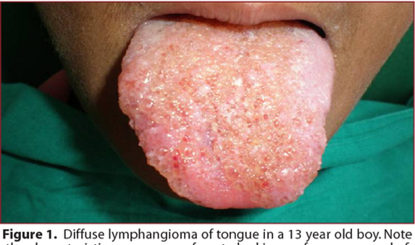 <p>A pediatric patient presents with a lesion on the tongue that has a pebbly, vesicle-like surface. Upon palpation, a crackling (crepitus) sensation is noted.</p><p>What is the most likely diagnosis?</p>