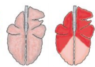 <p>What are these lung patterns together? Describe it. 3 example causes. </p>