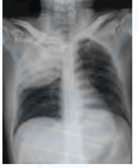 <p>Klebsiella pneumonia ( red current jelly sputum )</p>