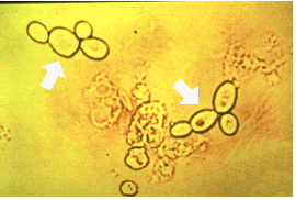 <p>The elements indicated by the arrows are more likely to be seen in patients with which condition?</p><p>Bacterial infection</p><p>Nephrotic syndrome</p><p>Diabetes</p><p>Renal failure </p>