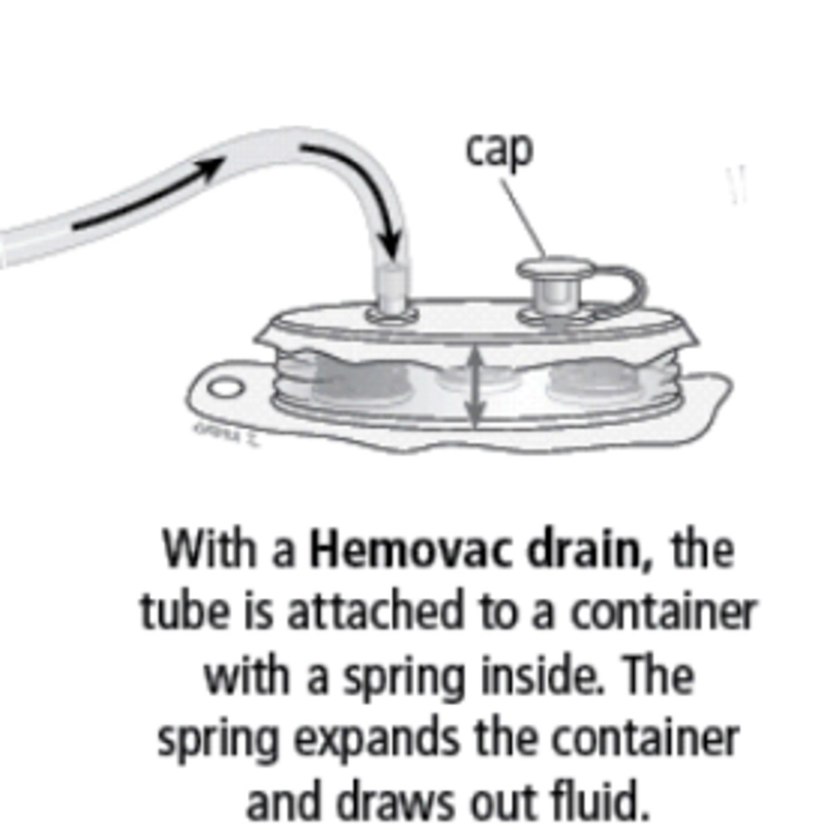 <p>Hemovac drains are more common in _______________________. If in place, don't be very aggressive /c ROM. These are also ________________________ drains.</p>