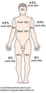 <p>Used to estimate total burn damage, and used to determine treatment needed for a patient </p>