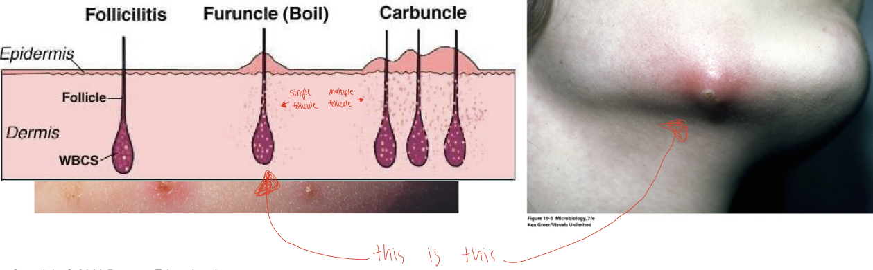 Folliculitis: hair follicle infection

* sty: folliculitis of an eyelash
* furuncle: abscess, pus surrounded by inflamed tissue
* carbuncle: inflammation of skin tissue usually leading to fever

Impetigo: highly contagious, crusting sores that spread easily to surrounding areas, occurs mostly in children